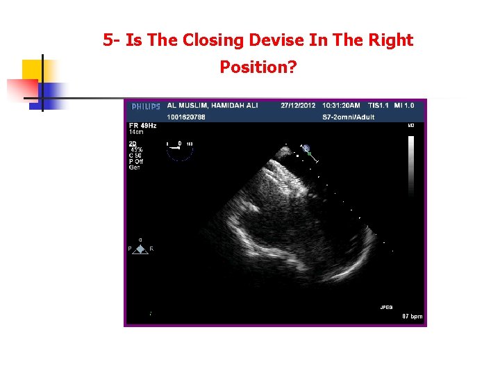 5 - Is The Closing Devise In The Right Position? 5 - Is The Closing Devise In The Right Position?