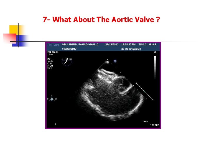 7 - What About The Aortic Valve ? 7 - What About The Aortic Valve ?
