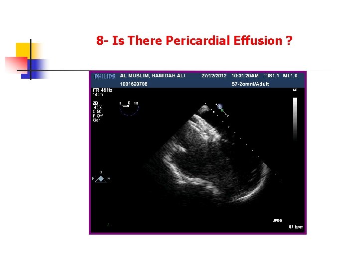 8 - Is There Pericardial Effusion ? 8 - Is There Pericardial Effusion ?
