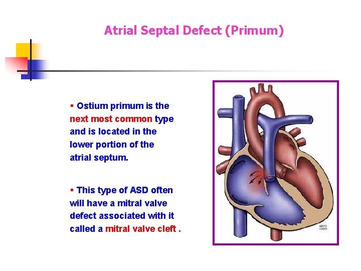 Atrial Septal Defect (Primum) § Ostium primum is the next most common type and Atrial Septal Defect (Primum) § Ostium primum is the next most common type and