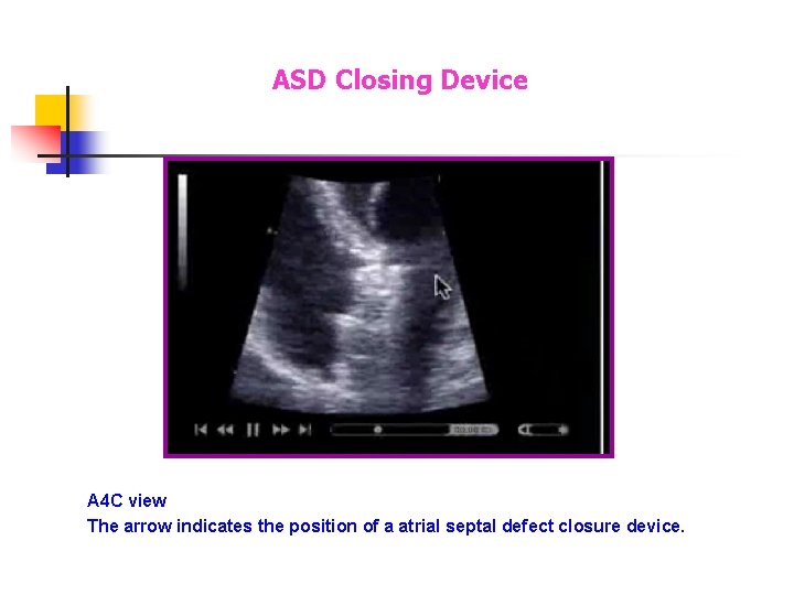ASD Closing Device A 4 C view The arrow indicates the position of a ASD Closing Device A 4 C view The arrow indicates the position of a