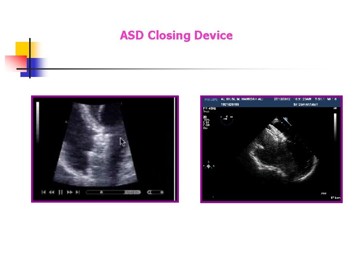 ASD Closing Device ASD Closing Device