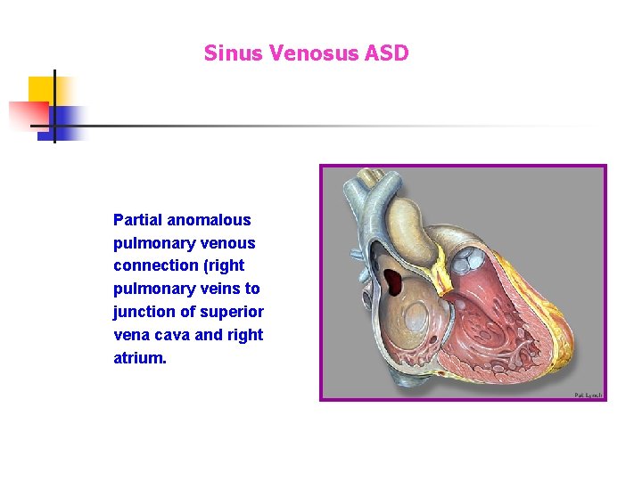 Sinus Venosus ASD Partial anomalous pulmonary venous connection (right pulmonary veins to junction of Sinus Venosus ASD Partial anomalous pulmonary venous connection (right pulmonary veins to junction of