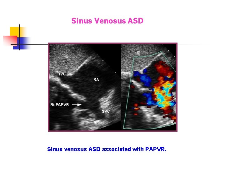 Sinus Venosus ASD Sinus venosus ASD associated with PAPVR. Sinus Venosus ASD Sinus venosus ASD associated with PAPVR.