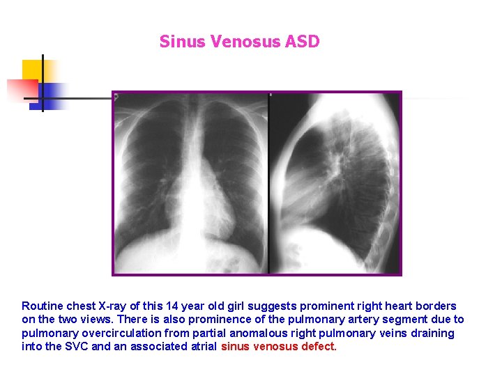 Sinus Venosus ASD Routine chest X-ray of this 14 year old girl suggests prominent Sinus Venosus ASD Routine chest X-ray of this 14 year old girl suggests prominent