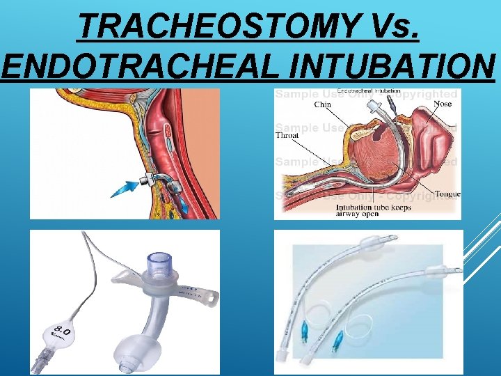 TRACHEOSTOMY Vs. ENDOTRACHEAL INTUBATION 