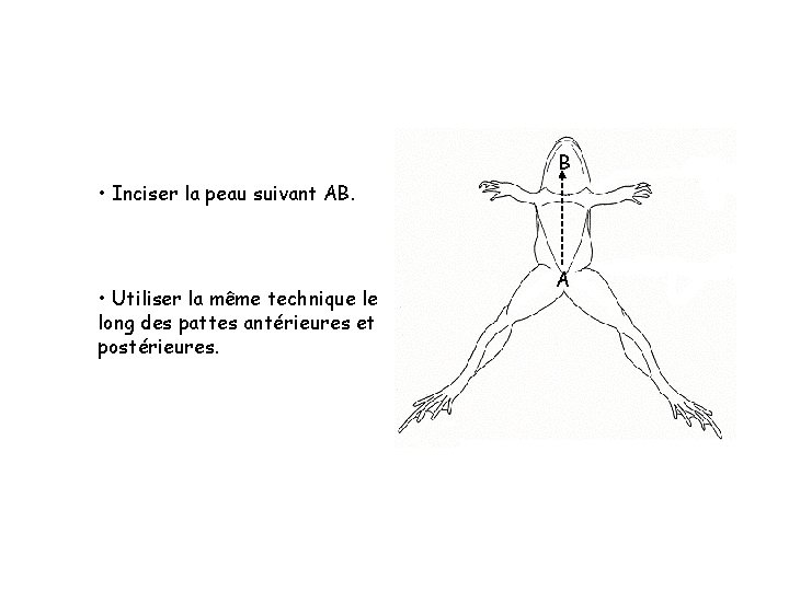 B • Inciser la peau suivant AB. • Utiliser la même technique le long B • Inciser la peau suivant AB. • Utiliser la même technique le long