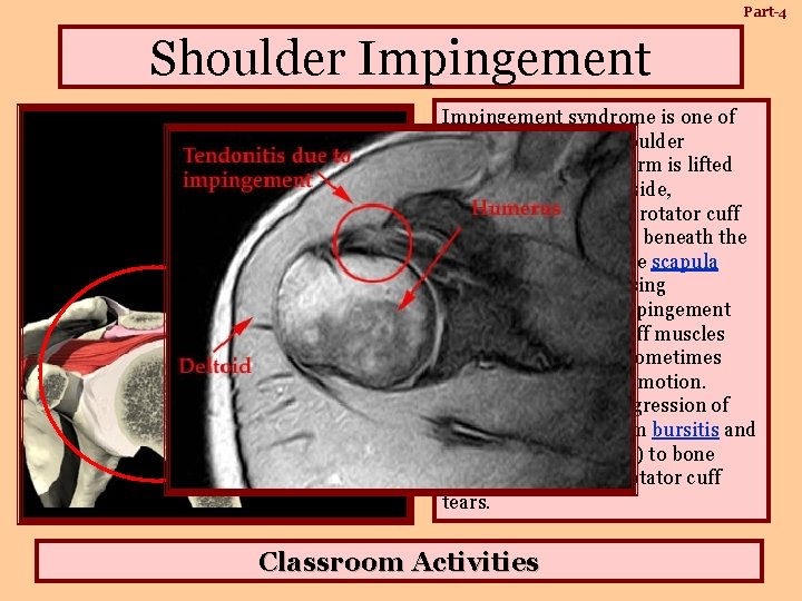 Part-4 Shoulder Impingement syndrome is one of the most common shoulder problems. When the