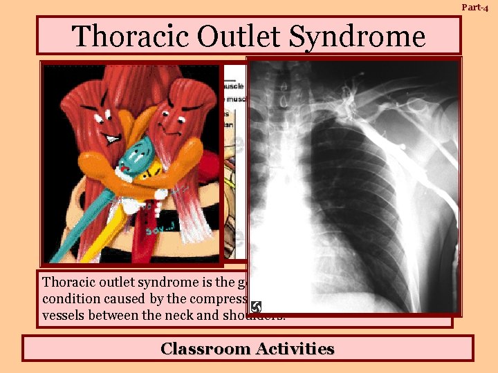 Part-4 Thoracic Outlet Syndrome Thoracic outlet syndrome is the general term used to describe