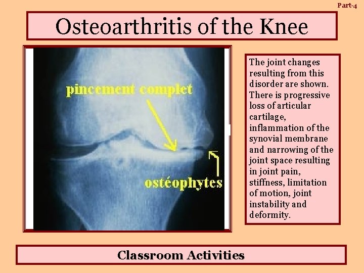 Part-4 Osteoarthritis of the Knee Bone Cysts Osteophyte Narrowing of Joint Space Erosion of