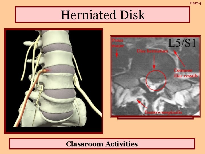 Part-4 Herniated Disk As a disc between two vertebrae degenerates, its inner nucleus may