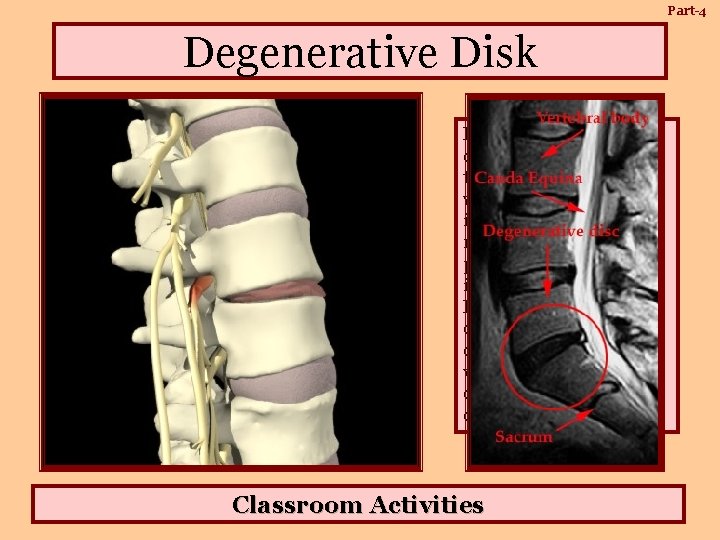 Part-4 Degenerative Disk Lumbar and cervical disc degeneration cause the discs to collapse, which