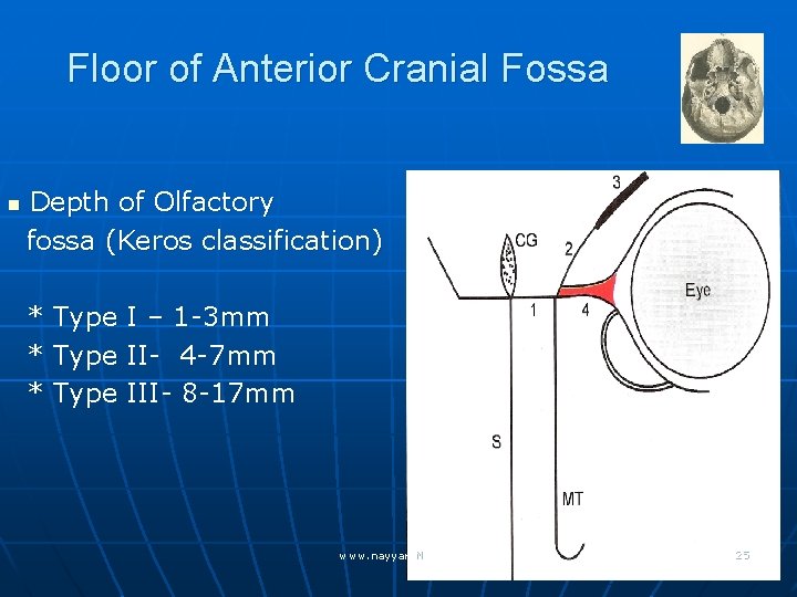 Floor of Anterior Cranial Fossa n Depth of Olfactory fossa (Keros classification) * *