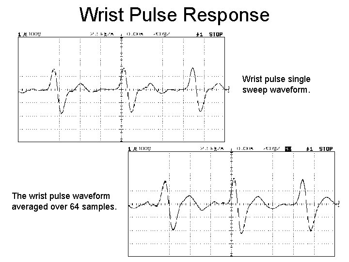 Wrist Pulse Response Wrist pulse single sweep waveform. The wrist pulse waveform averaged over