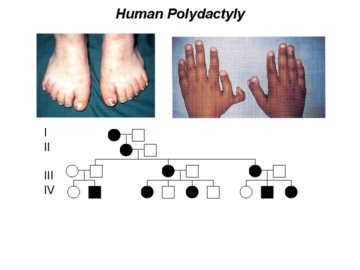 Human Polydactyly I II IV 