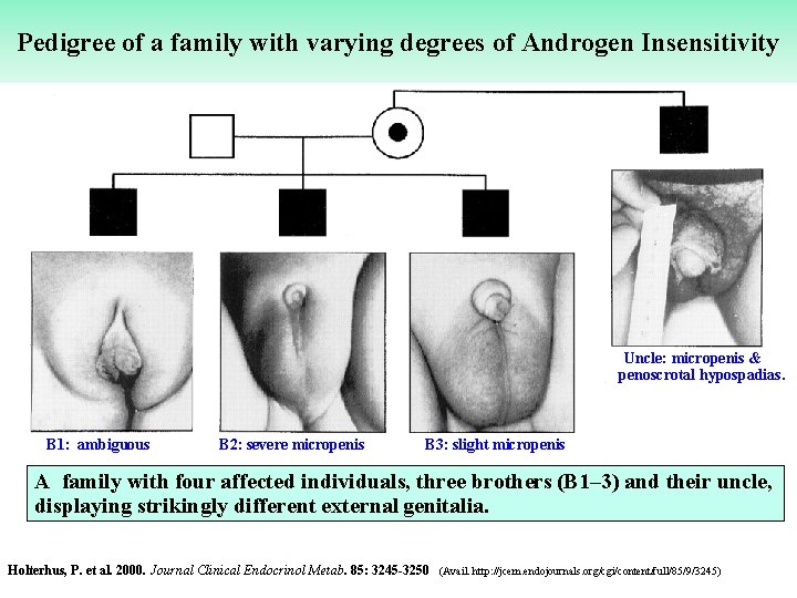 Pedigree of a family with varying degrees of Androgen Insensitivity • Uncle: micropenis &
