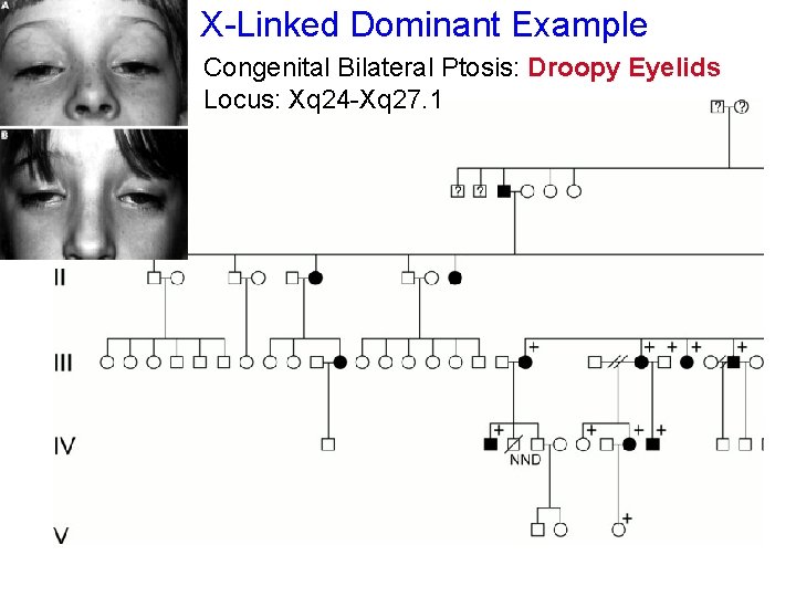 X-Linked Dominant Example Congenital Bilateral Ptosis: Droopy Eyelids Locus: Xq 24 -Xq 27. 1