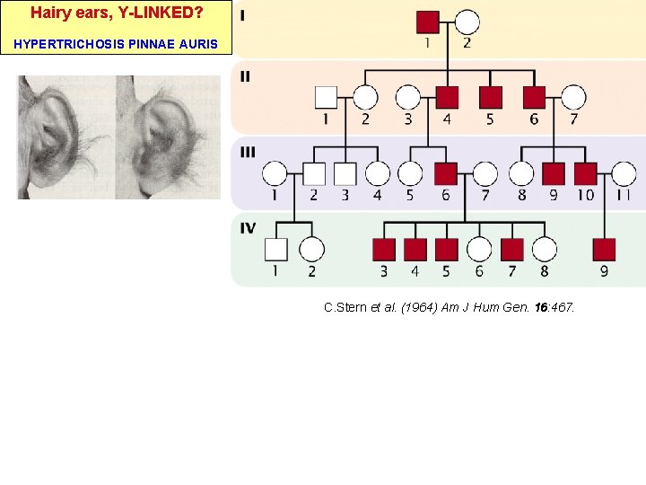 Hairy ears, Y-LINKED? HYPERTRICHOSIS PINNAE AURIS C. Stern et al. (1964) Am J Hum