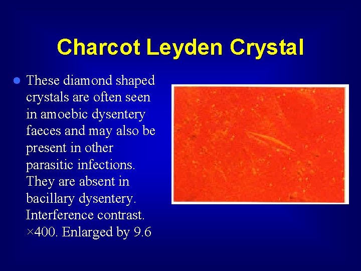Charcot Leyden Crystal l These diamond shaped crystals are often seen in amoebic dysentery