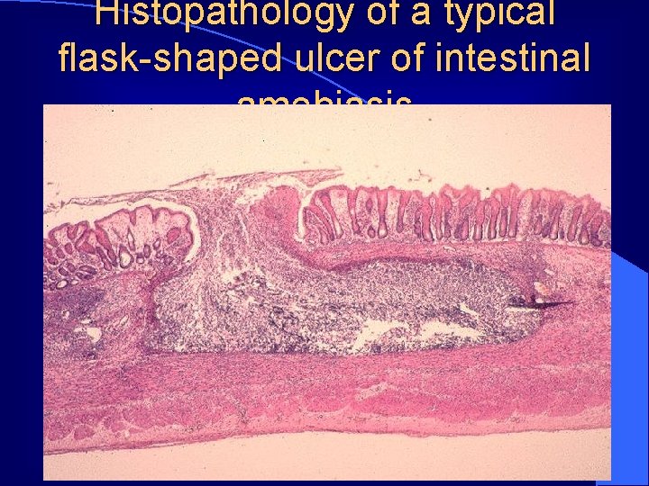 Histopathology of a typical flask-shaped ulcer of intestinal amebiasis 