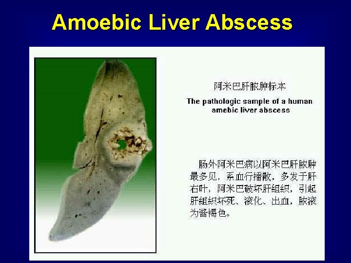 Amoebic Liver Abscess 
