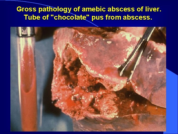 Gross pathology of amebic abscess of liver. Tube of "chocolate" pus from abscess. 