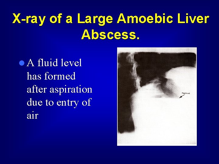 X-ray of a Large Amoebic Liver Abscess. l A fluid level has formed after