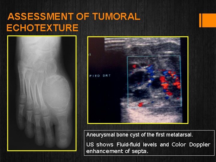 ASSESSMENT OF TUMORAL ECHOTEXTURE Aneurysmal bone cyst of the first metatarsal. US shows Fluid-fluid
