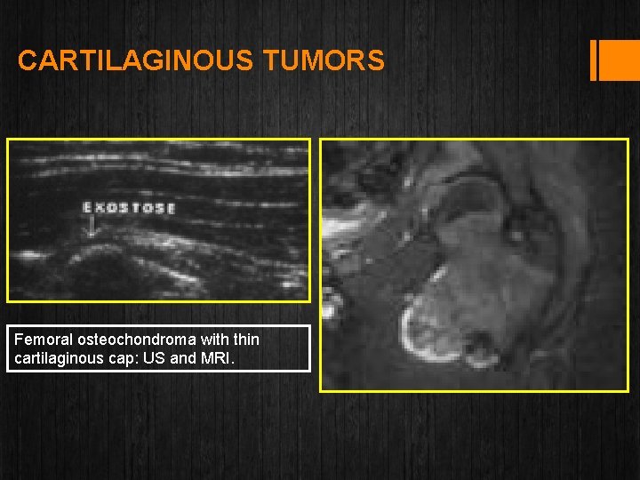 CARTILAGINOUS TUMORS Femoral osteochondroma with thin cartilaginous cap: US and MRI. 