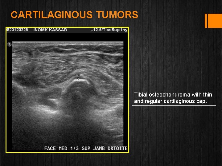 CARTILAGINOUS TUMORS Tibial osteochondroma with thin and regular cartilaginous cap. 