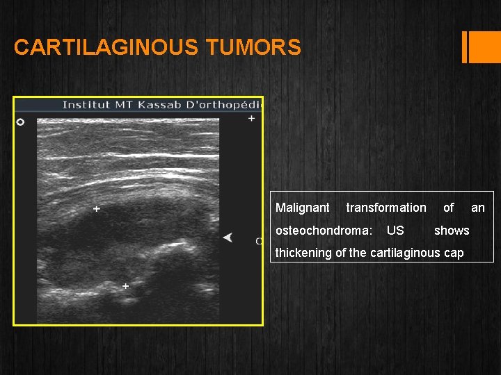 CARTILAGINOUS TUMORS Malignant transformation of an osteochondroma: US shows thickening of the cartilaginous cap