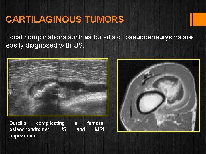CARTILAGINOUS TUMORS Local complications such as bursitis or pseudoaneurysms are easily diagnosed with US.