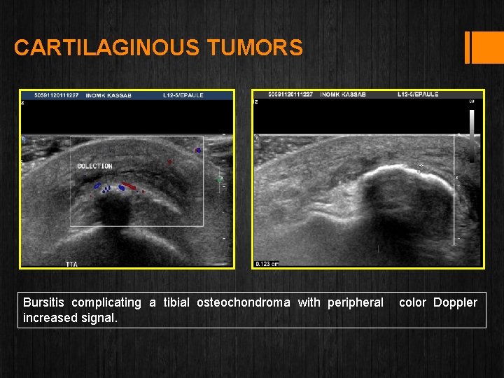 CARTILAGINOUS TUMORS Bursitis complicating a tibial osteochondroma with peripheral color Doppler increased signal. 