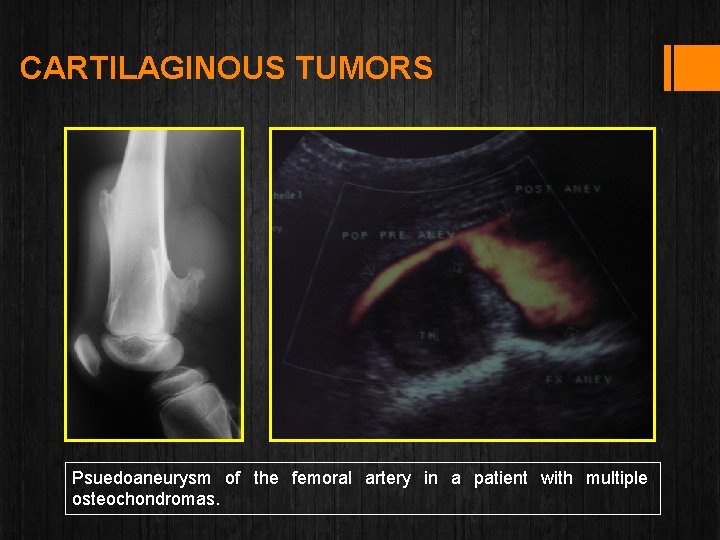 CARTILAGINOUS TUMORS Psuedoaneurysm of the femoral artery in a patient with multiple osteochondromas. 