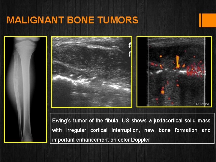 MALIGNANT BONE TUMORS Ewing’s tumor of the fibula. US shows a juxtacortical solid mass