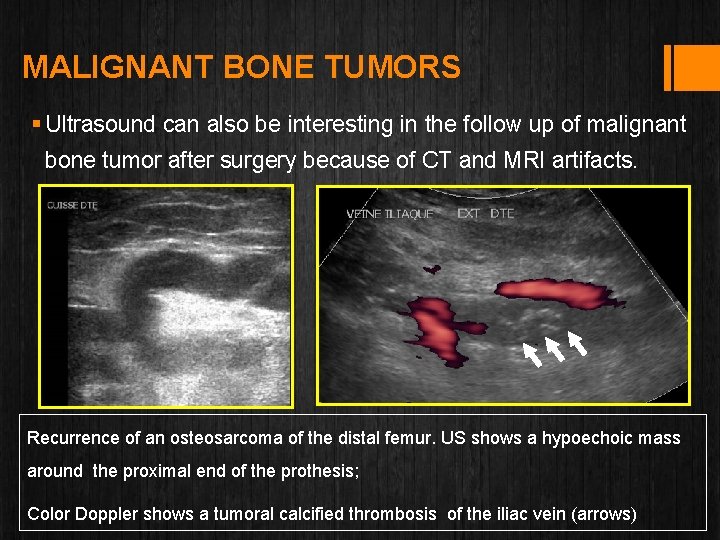 MALIGNANT BONE TUMORS § Ultrasound can also be interesting in the follow up of