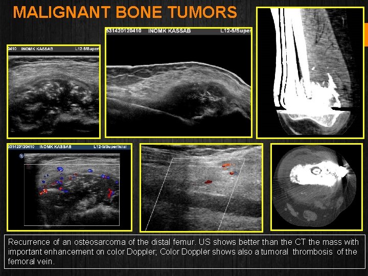 MALIGNANT BONE TUMORS Recurrence of an osteosarcoma of the distal femur. US shows better