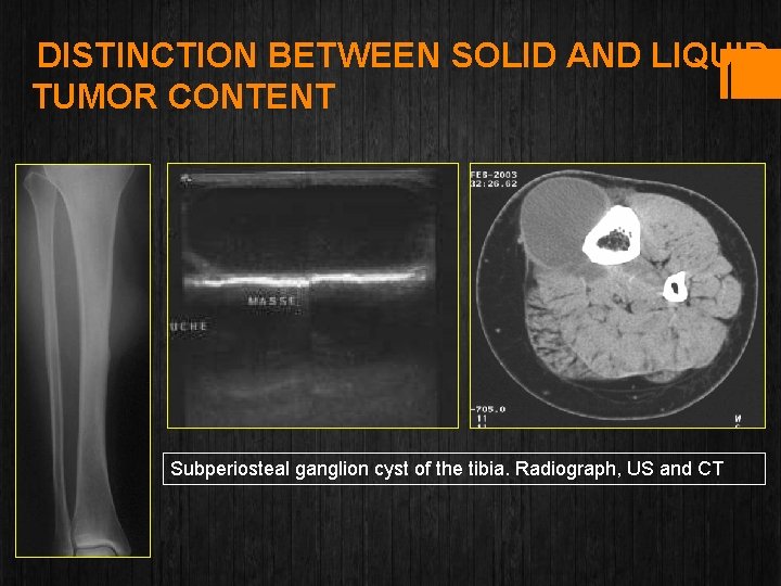 DISTINCTION BETWEEN SOLID AND LIQUID TUMOR CONTENT Subperiosteal ganglion cyst of the tibia. Radiograph,