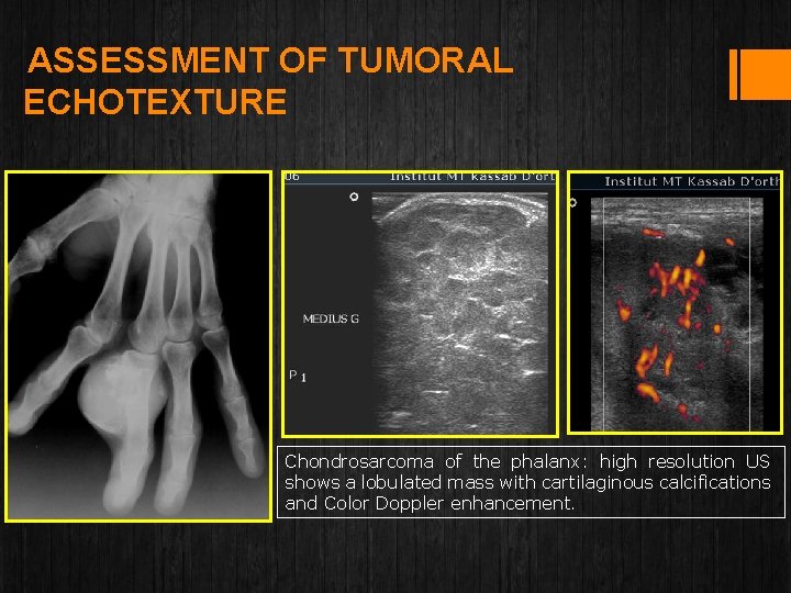 ASSESSMENT OF TUMORAL ECHOTEXTURE Chondrosarcoma of the phalanx: high resolution US shows a lobulated
