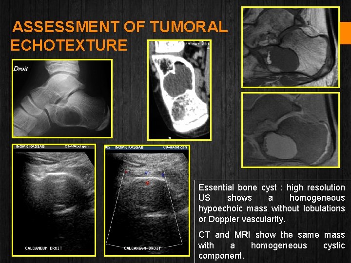 ASSESSMENT OF TUMORAL ECHOTEXTURE Essential bone cyst : high resolution US shows a homogeneous