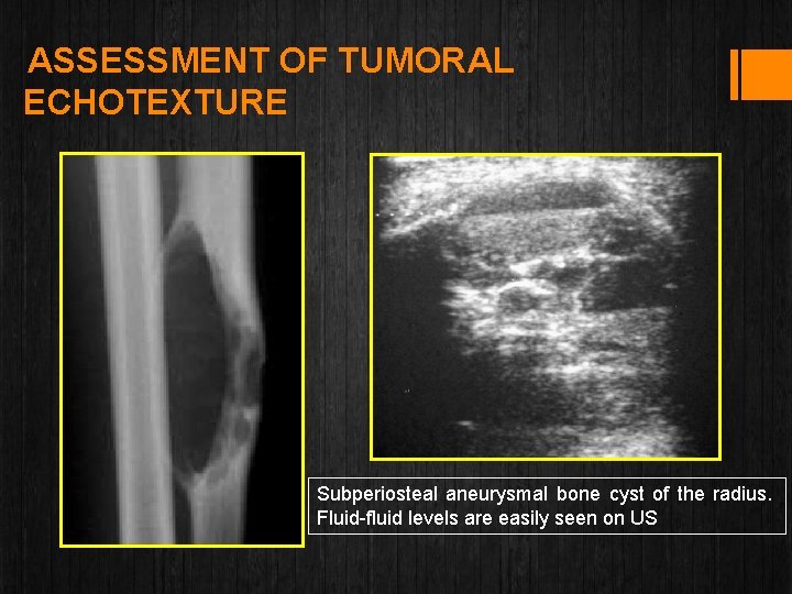 ASSESSMENT OF TUMORAL ECHOTEXTURE Subperiosteal aneurysmal bone cyst of the radius. Fluid-fluid levels are