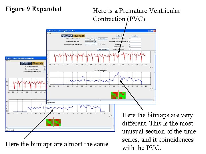 Figure 9 Expanded Here is a Premature Ventricular Contraction (PVC) Here the bitmaps are