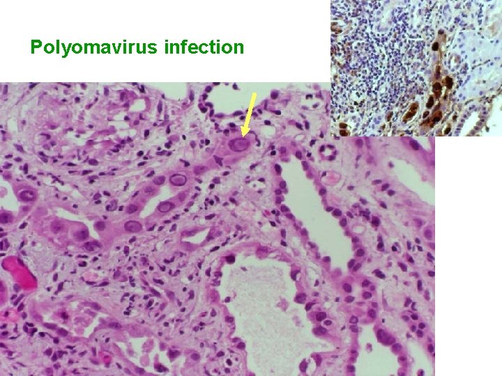 Polyomavirus infection 