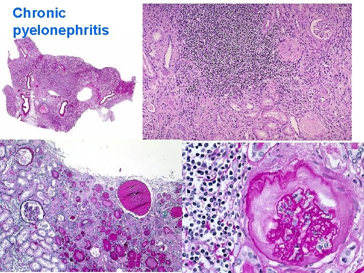 Chronic pyelonephritis 