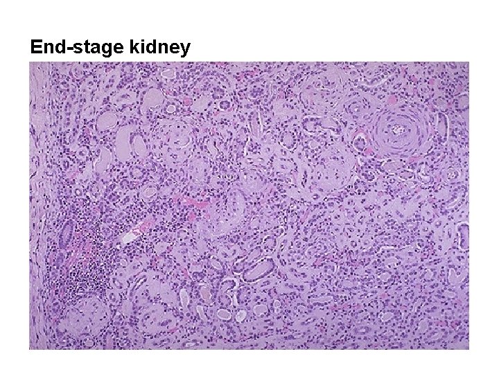End-stage kidney 