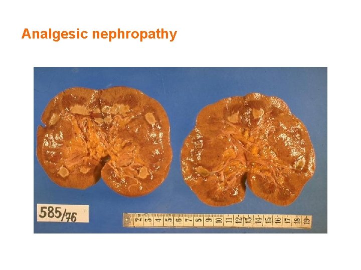 Analgesic nephropathy 