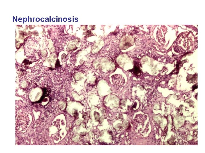Nephrocalcinosis 