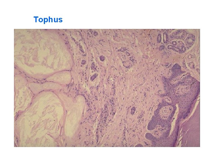 Tophus 