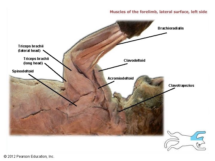 Brachioradialis Triceps brachii (lateral head) Triceps brachii (long head) Clavodeltoid Spinodeltoid Acromiodeltoid Clavotrapezius ©