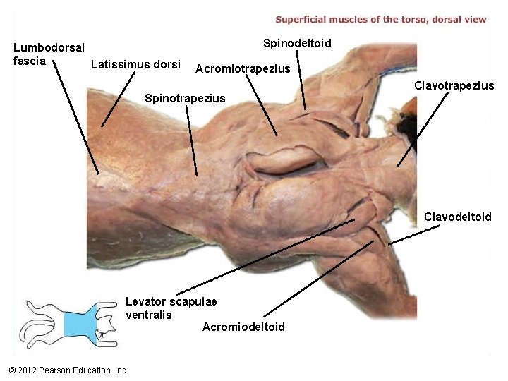 Lumbodorsal fascia Latissimus dorsi Spinodeltoid Acromiotrapezius Clavotrapezius Spinotrapezius Clavodeltoid Levator scapulae ventralis Acromiodeltoid ©